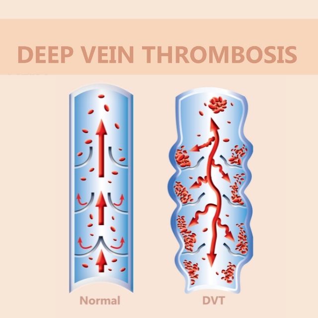 hernia treatment surgery in delhi